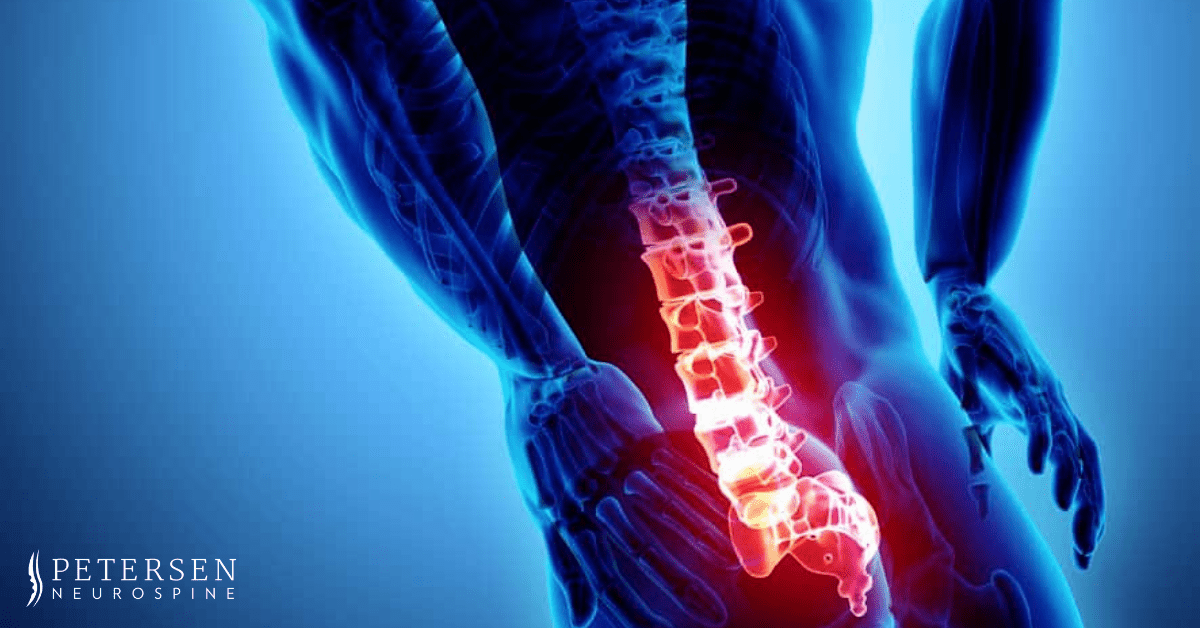 Spinal Stenosis Treatment - Find the Right Brace for You